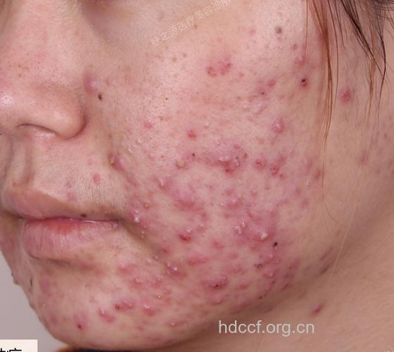 青春痘不同类型症状图片