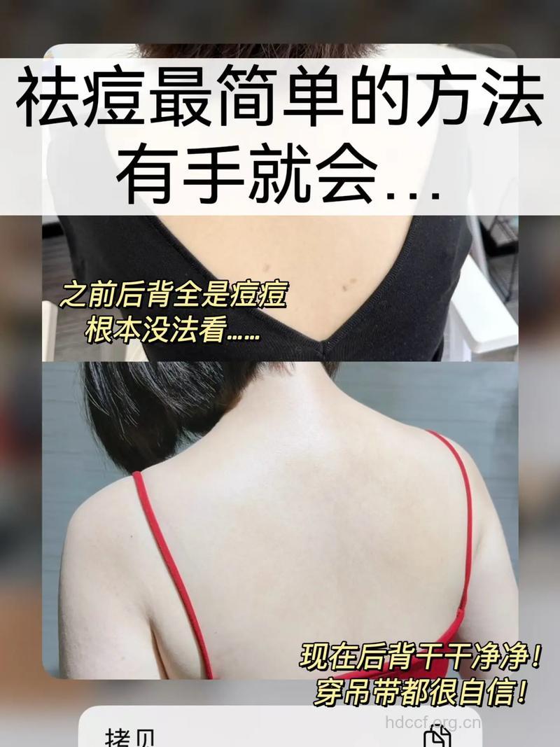 盐水洗浴能治疗背部痤疮吗