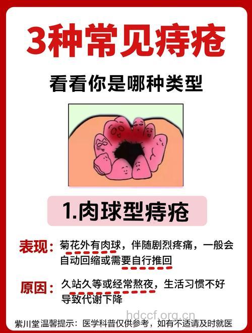 生活习惯与痔疮的亲密关系