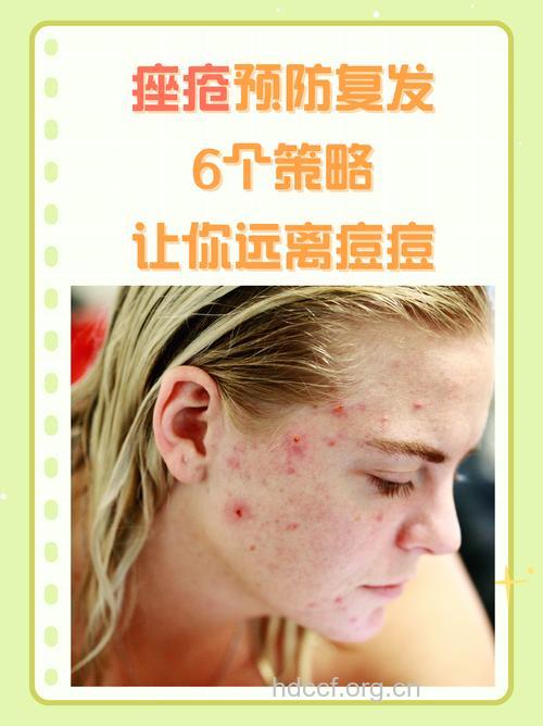 治青春痘 莫误入“歧途”
