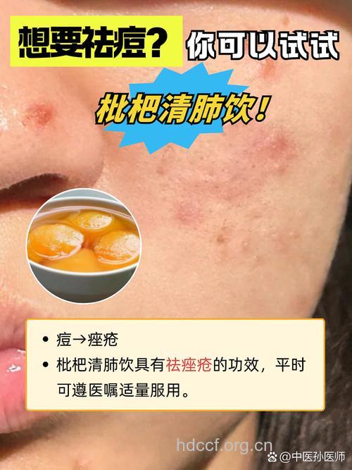 清肺消痤汤治痤疮
