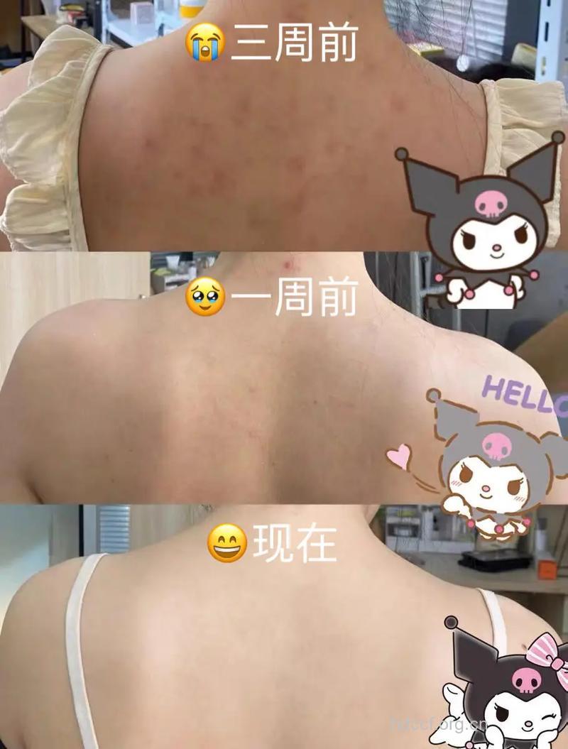 战痘高手经验:祛背部痘痘