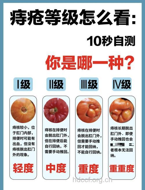 预防痔疮的十大妙招