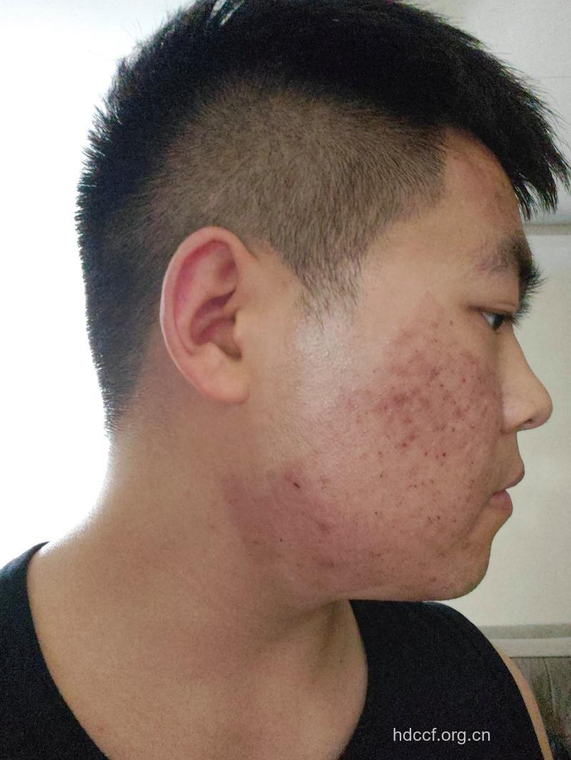 男性治疗青春痘有什么误区