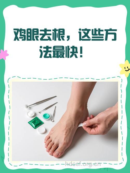 治疗鸡眼5种外用偏方
