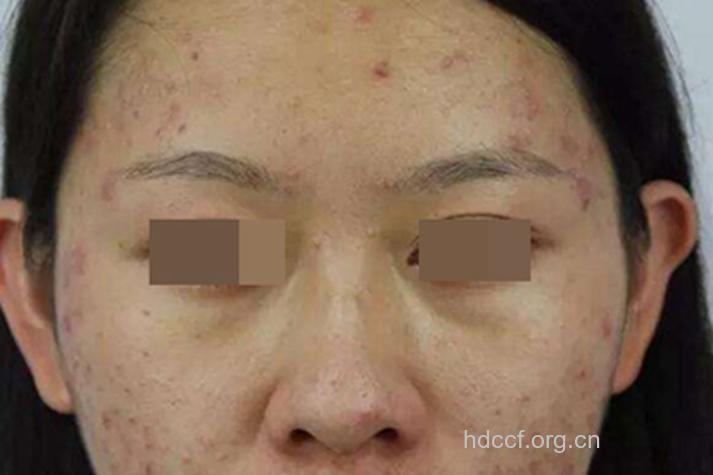 多囊卵巢导致痘痘有什么发病特点