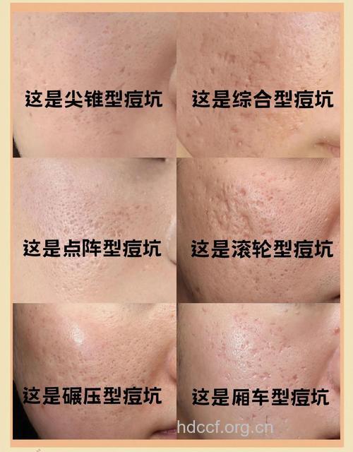 如何拯救痘痘留在脸上的“凹洞”