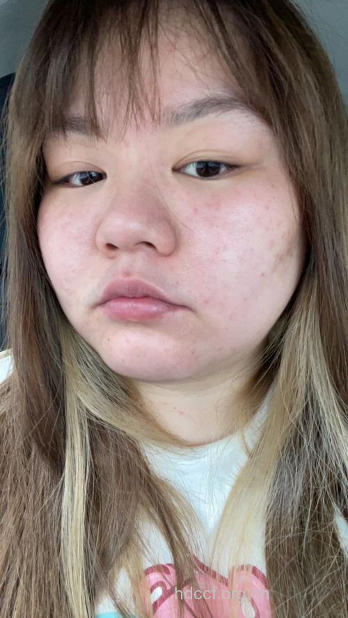 女性过于肥胖也会引发痤疮