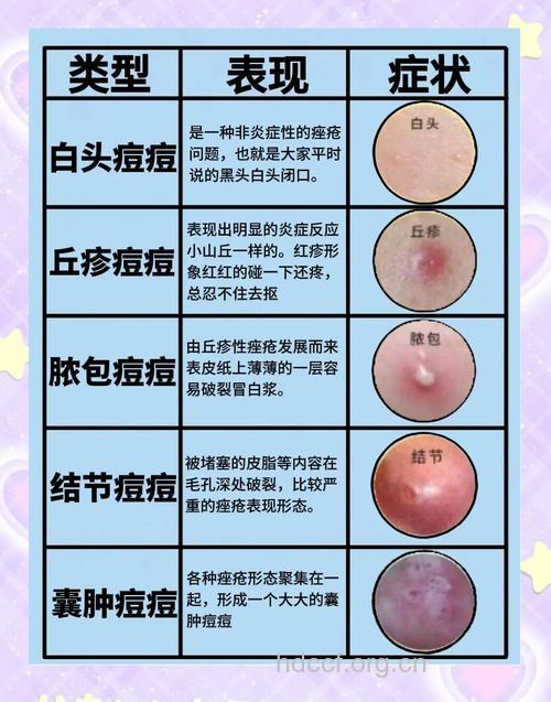 痤疮的症状有哪些表现