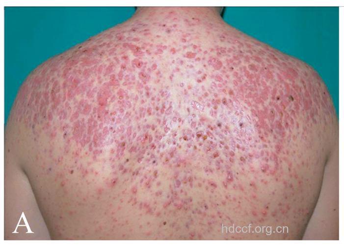 爆发性痤疮有什么症状