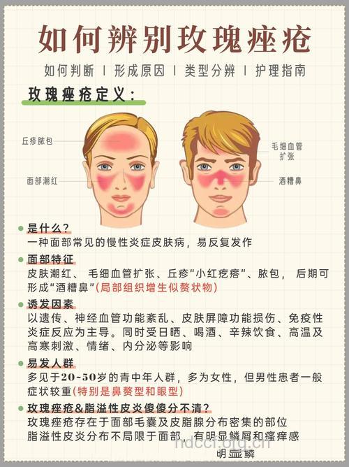 玫瑰痤疮是怎么样的