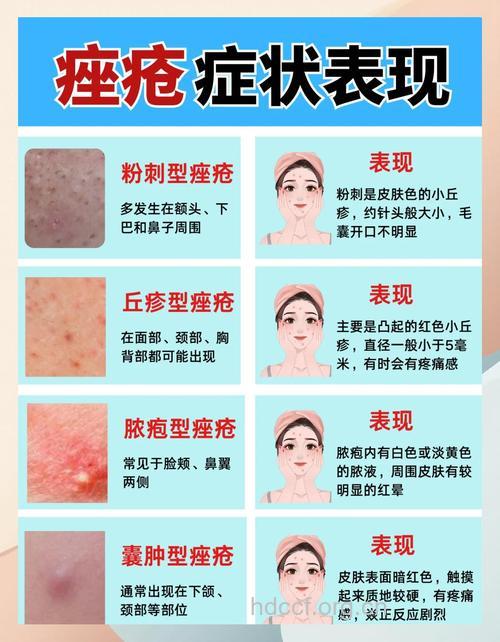 痤疮有哪些症状及分类