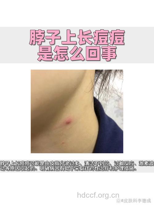 脖子上长痘痘是痤疮吗