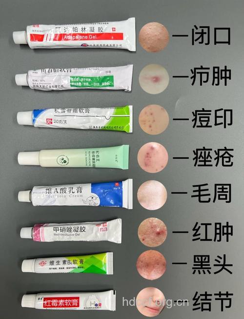 出现痤疮的内治方法