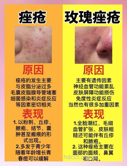 治疗痤疮的一些常见误区
