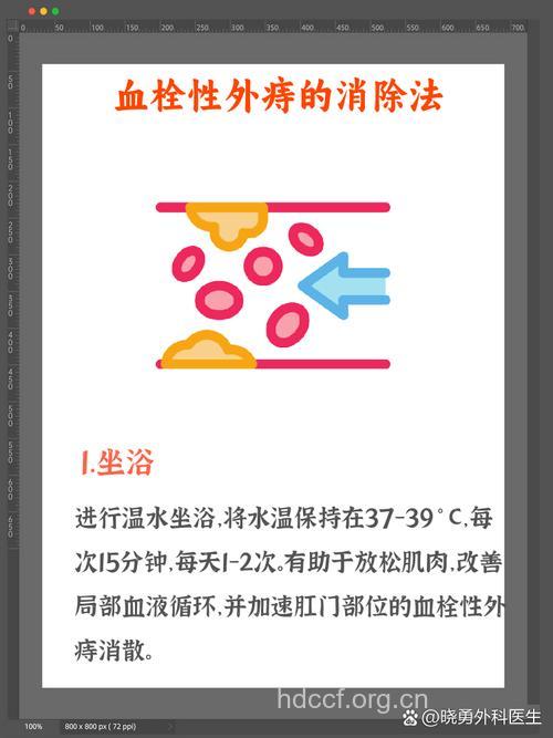 怎么预防血栓性外痔发生