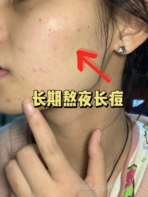 睡眠不足也会引起痤疮