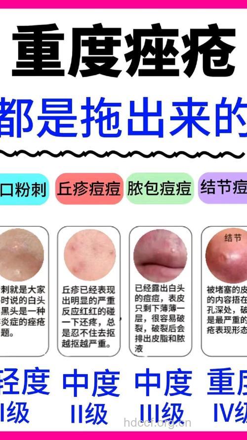 痤疮带来哪些严重危害