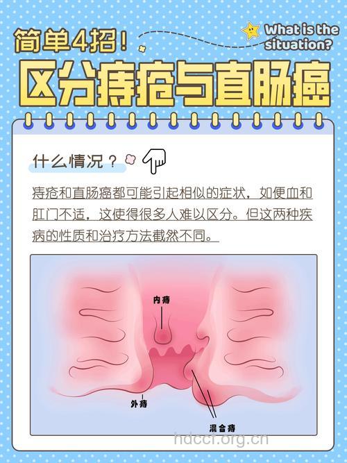 痔疮与大肠癌有什么区别吗