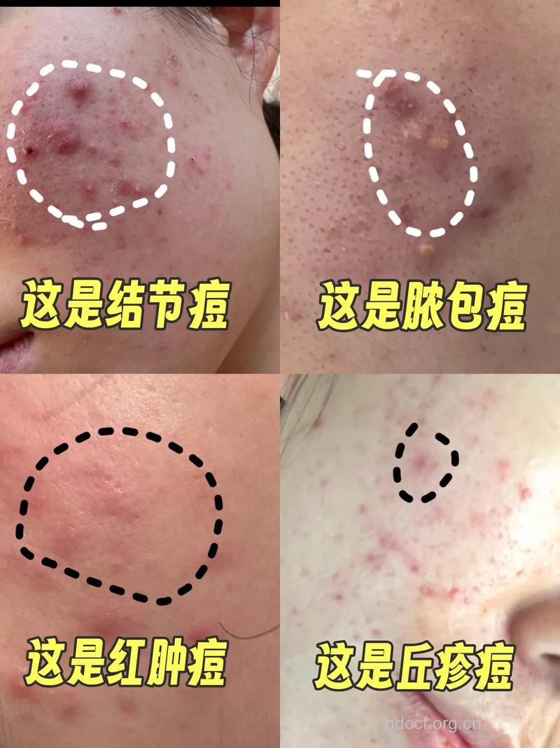 女人结婚后为什么还长痤疮