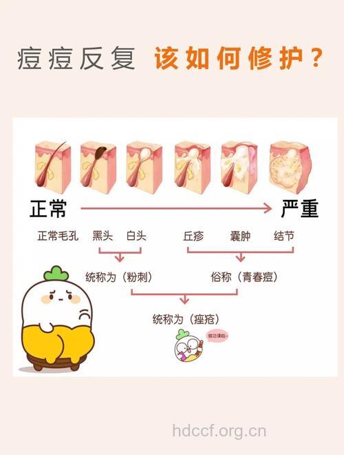 痤疮的形成原因有哪些