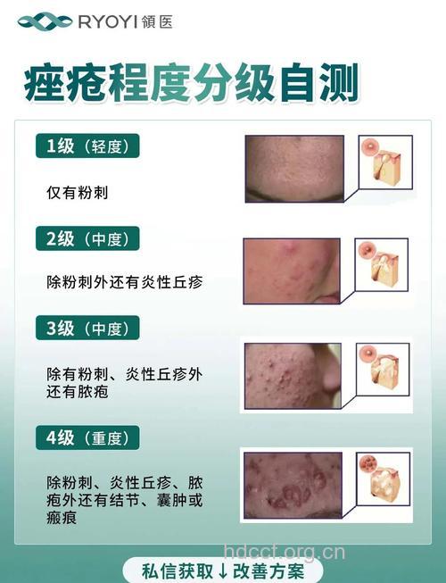 青少年痤疮与成年人痤疮的区别