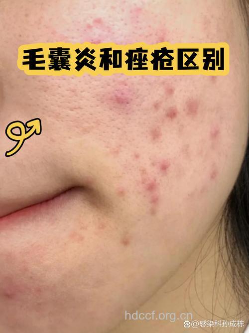 痤疮和毛囊炎具体有哪些区别