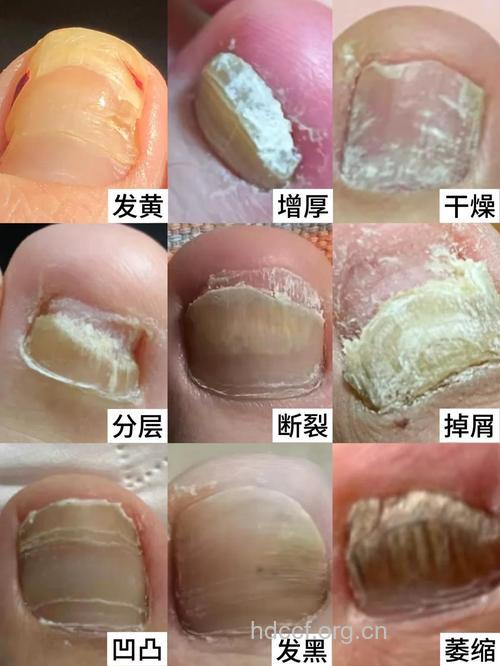 灰指甲治疗不当会得糖尿病足？