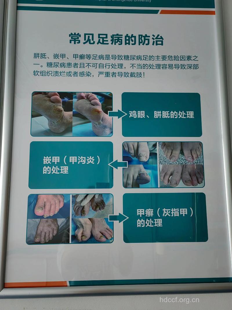 预防糖尿病足从脚部做起