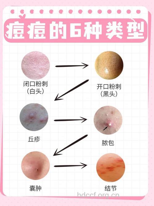 粉刺挤掉就真没事了吗？