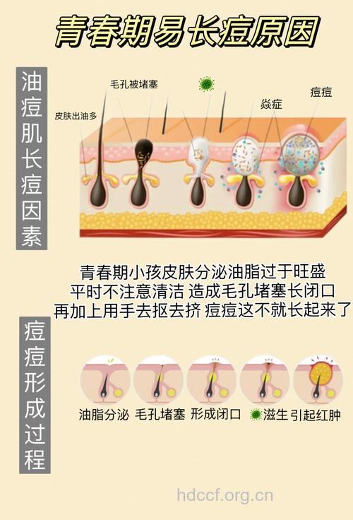 长青春痘该如何来调理？