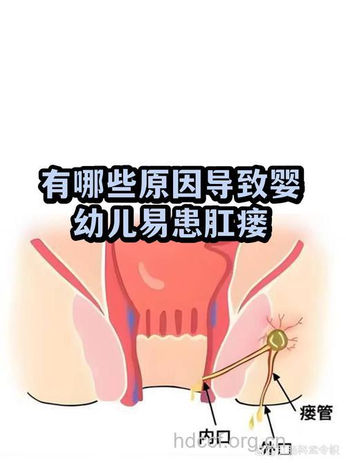 婴幼儿患肛瘘的因素