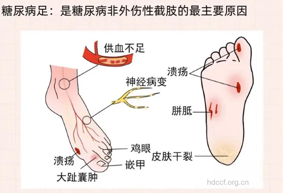 为什么糖尿病患者晚上脚疼?