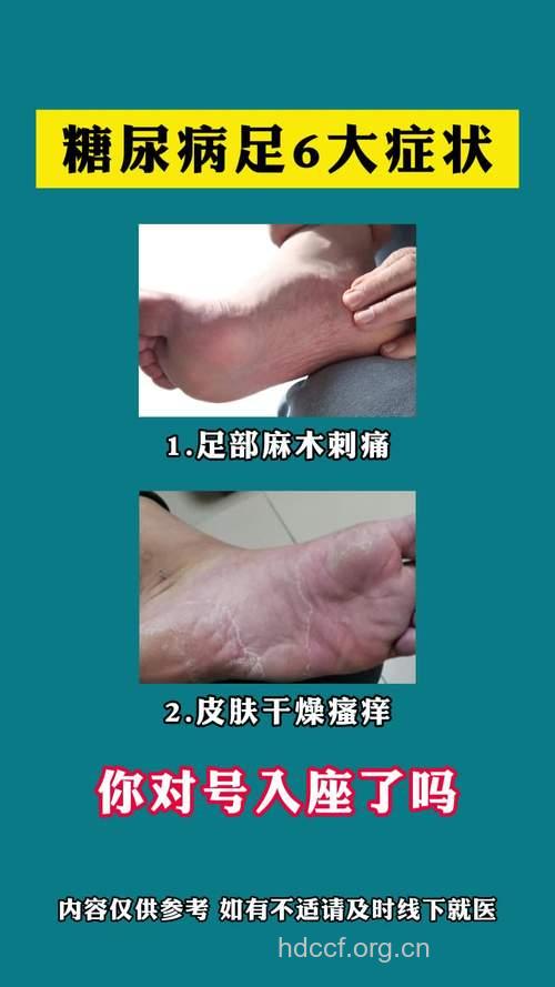 脚气会引发糖尿病足吗