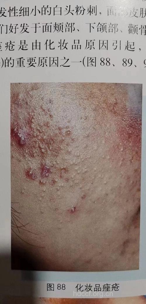 化妆品痤疮