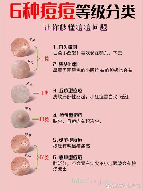 长痘痘未必都是青春痘