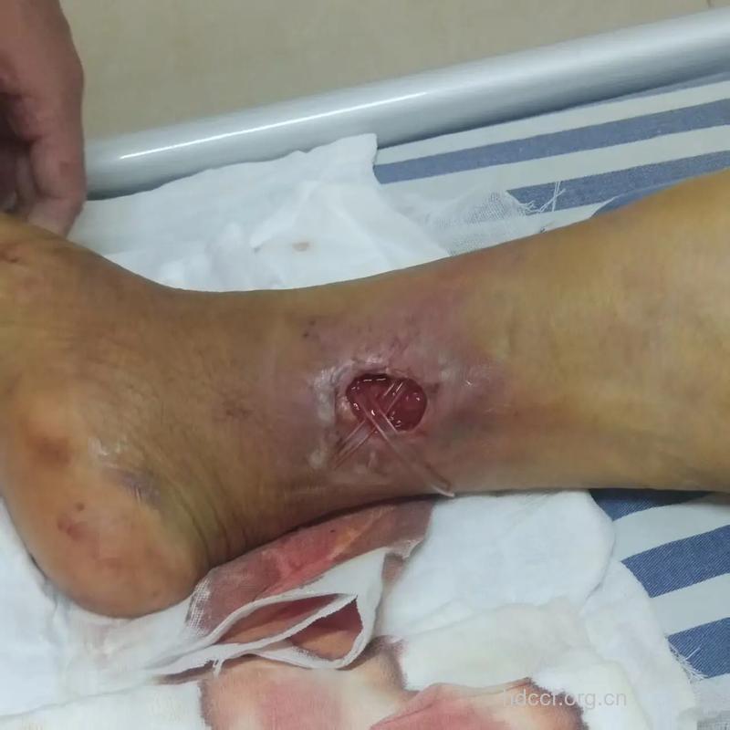 糖尿病患者：脚没受伤怎么溃烂了？