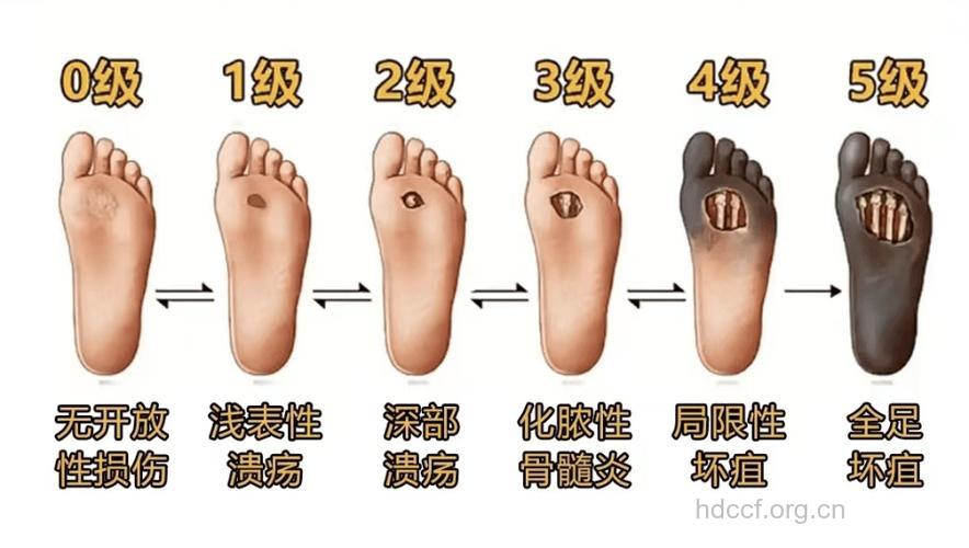 糖尿病肢端坏疽分级是什么?