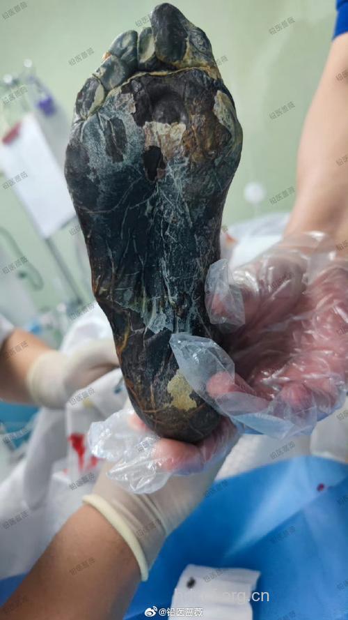 什么是糖尿病足干性坏疽？