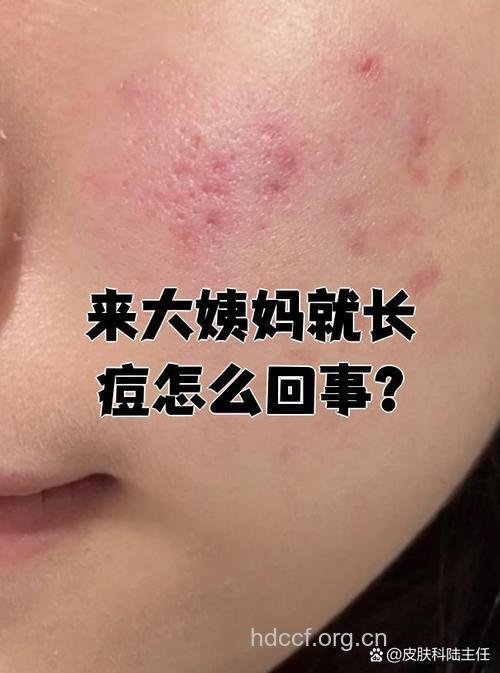 月经不调会引起痤疮吗