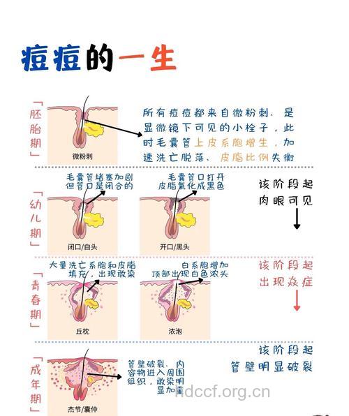 青春痘是如何形成的