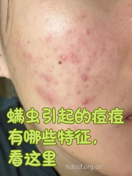 囊蹒虫作怪引发的青春痘
