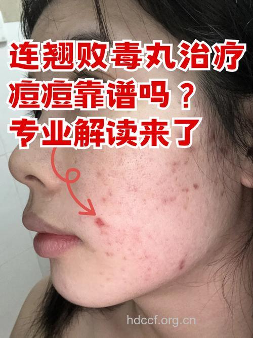 吃药会导致青春痘吗