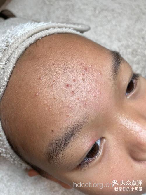 女儿满脸青春痘怎么办