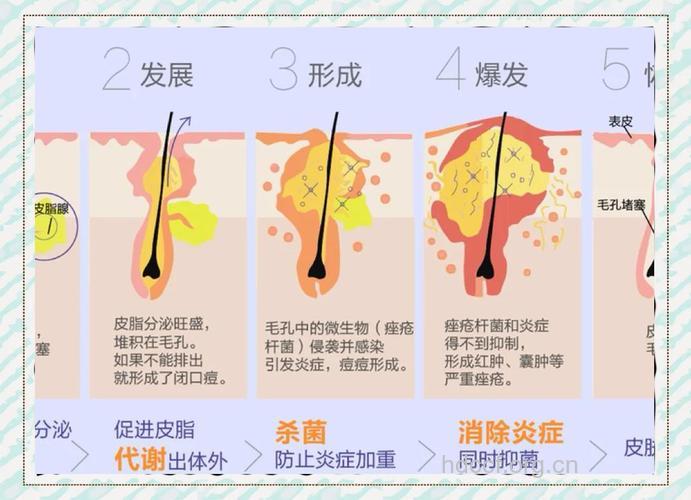痘痘是怎样出来的