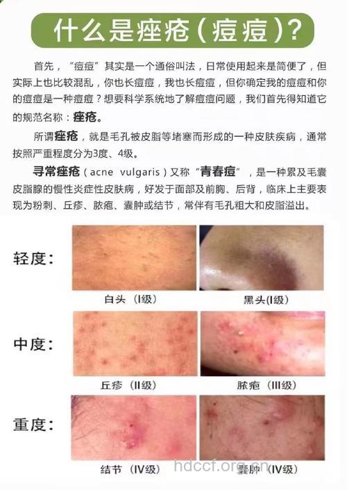 成年人生活方式引起痤疮
