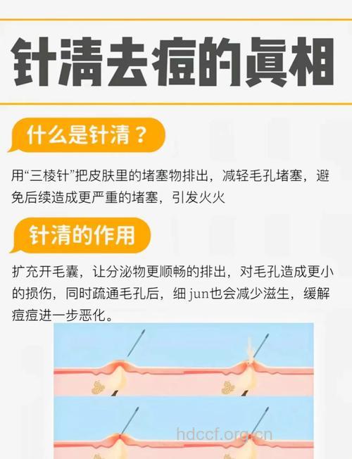 粉刺打疫苗预防好吗