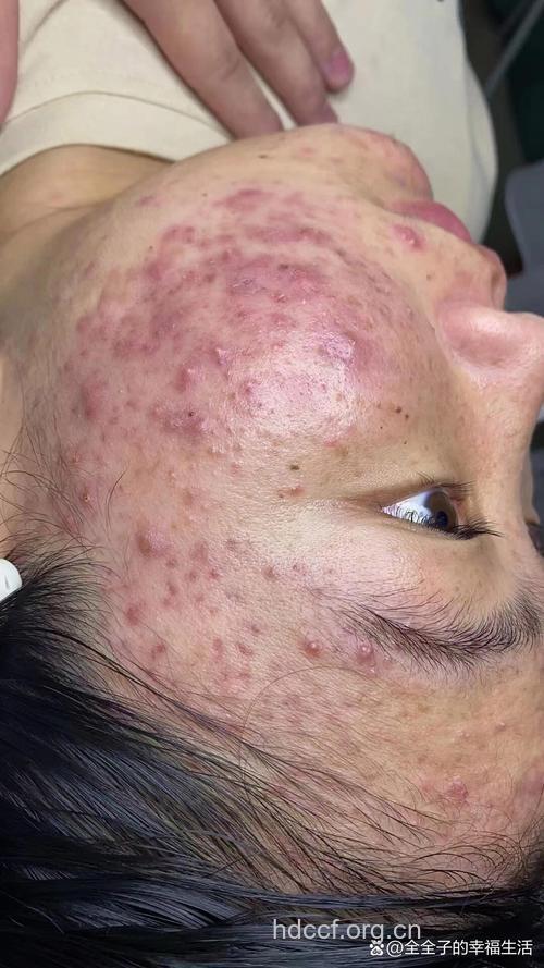 固醇激素青春痘