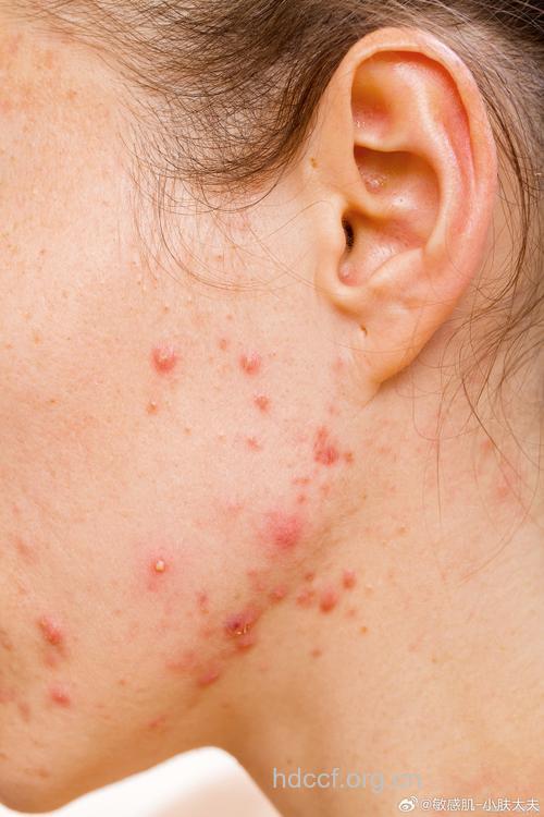 成年人长痘痘的困扰