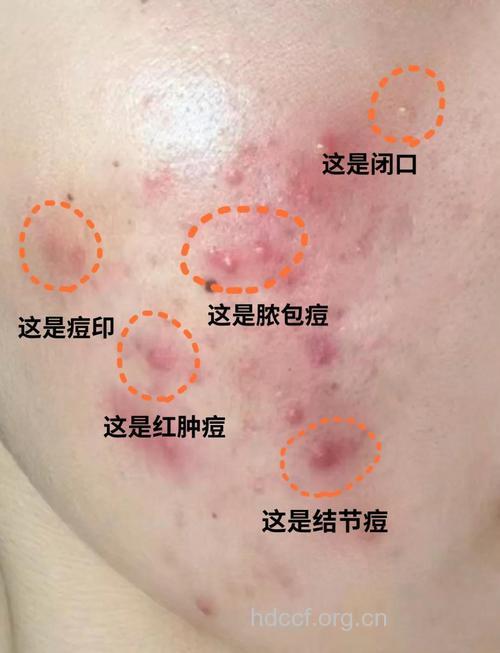 青春痘有多少种